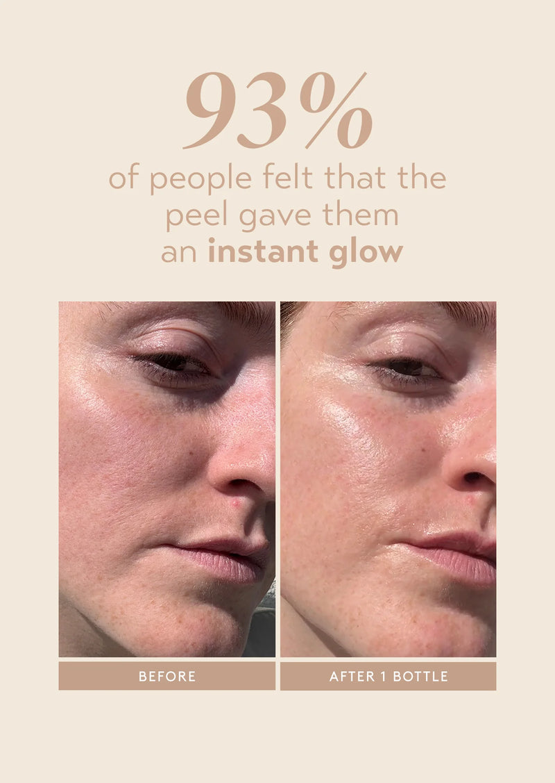 Triple Acid Signature Peel